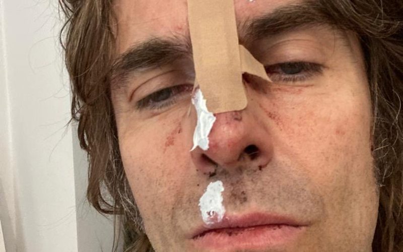 Liam Gallagher Injured After Falling From A Helicopter