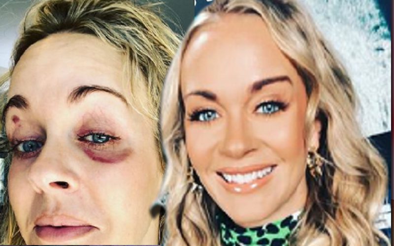 UFC’s Laura Sanko Shades Amber Heard After Sharing Post-Fight Injury Photo
